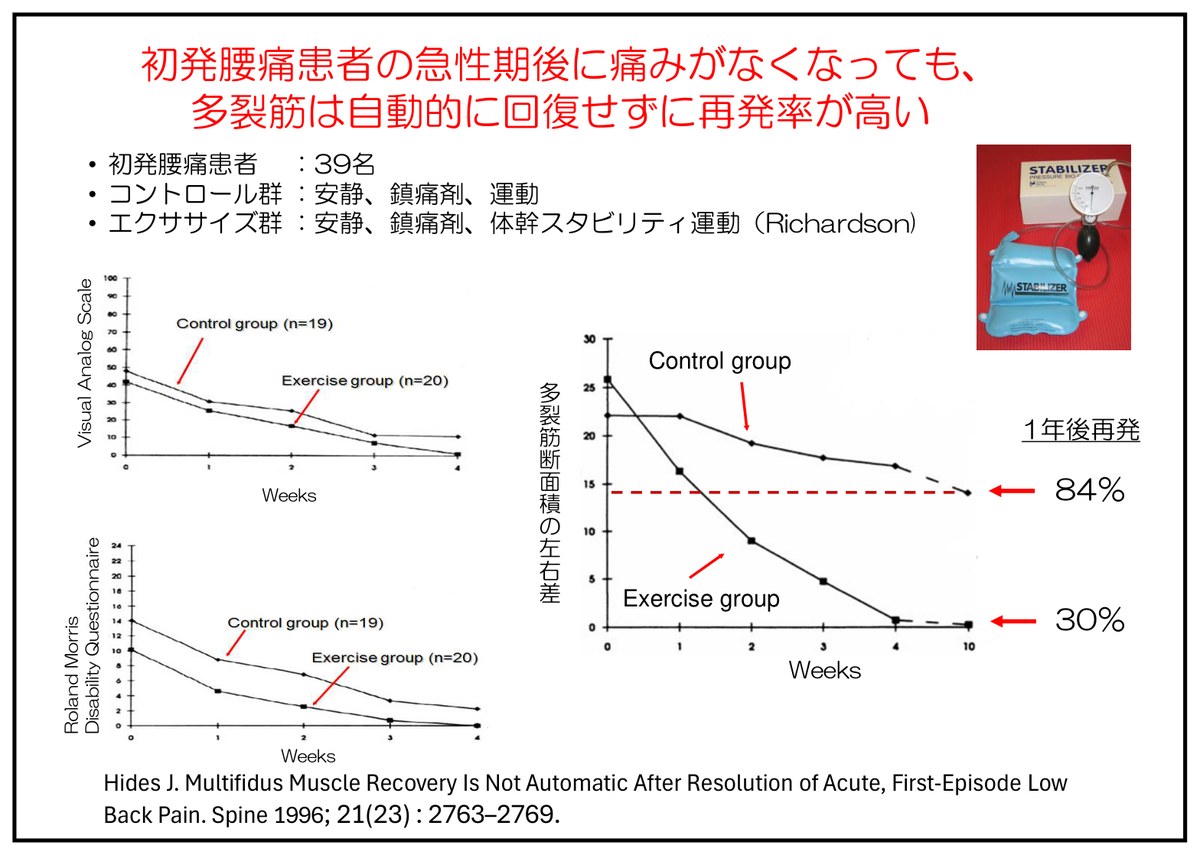 初発腰痛患者では急性期後に痛みがなくなっても、多裂筋は自動的に回復せず再発率が高い。運動を行った群と行わなかった群で再発率が異なる（Hides 1996）。
