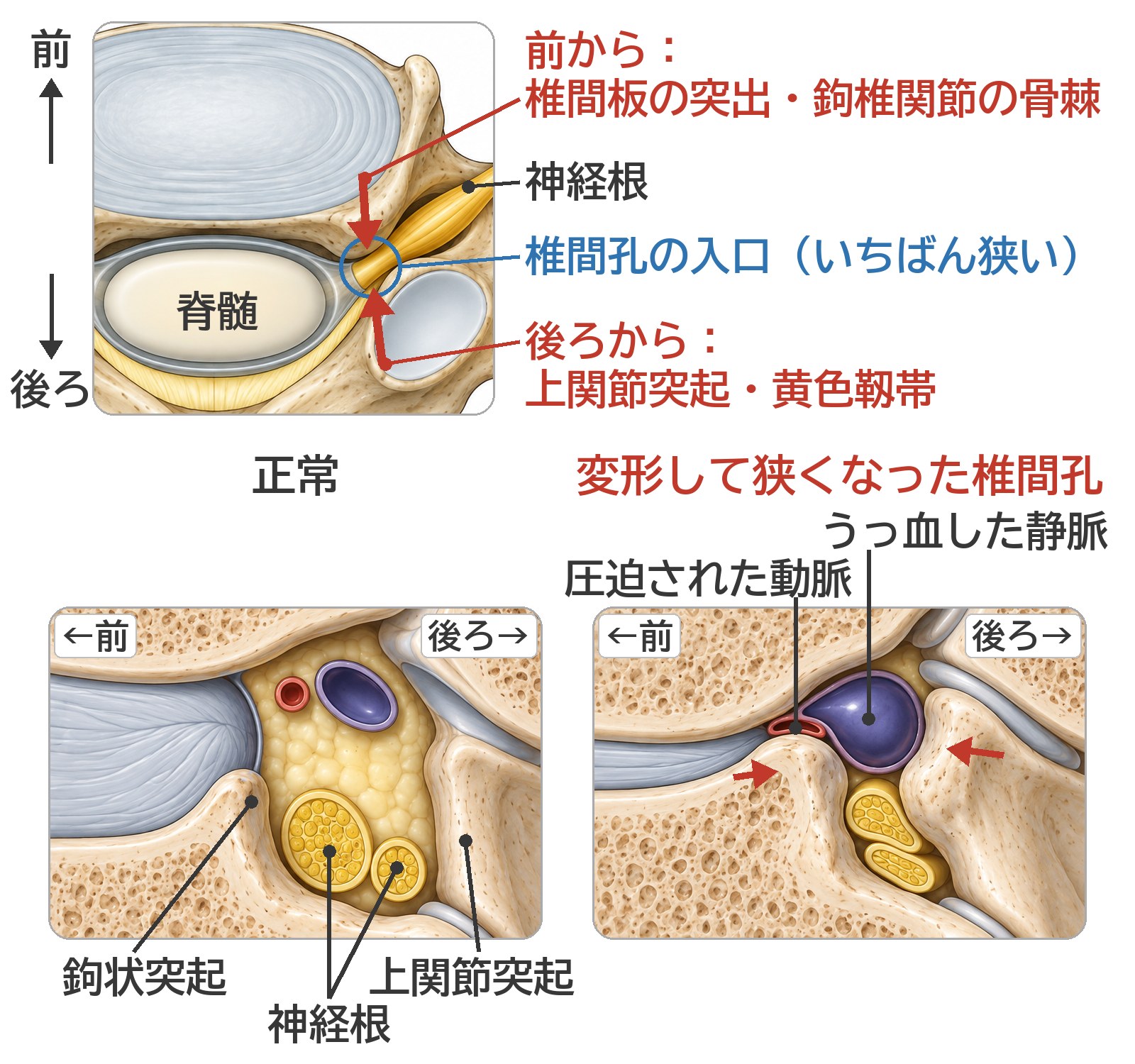 上の図は頸椎を上から見たところで、上が前。神経根が椎間孔の入口(いちばん狭いところ)で、前から椎間板の突出と鉤椎関節の骨棘に、後ろから上関節突起と黄色靱帯に圧迫されることを矢印で示す。下の2コマは椎間孔を横に切った断面で、左が前。正常な状態と、鉤状突起と上関節突起が変形して椎間孔が狭くなり、動脈が圧迫され、静脈がうっ血した状態を並べている