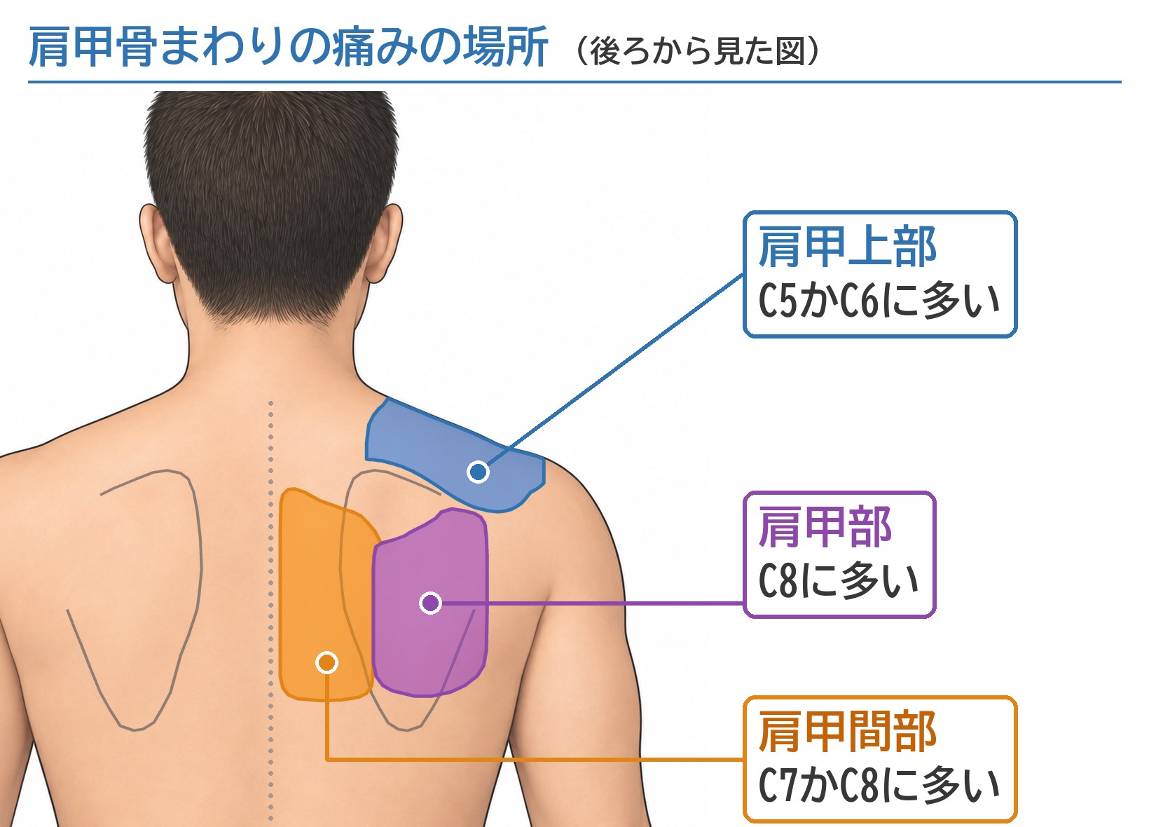 後ろから見た上半身の図。右の肩甲骨まわりを3色で塗り分けている。肩の上の肩甲上部はC5かC6、肩甲骨の上の肩甲部はC8、肩甲骨と背骨の間の肩甲間部はC7かC8の神経根の障害に多い