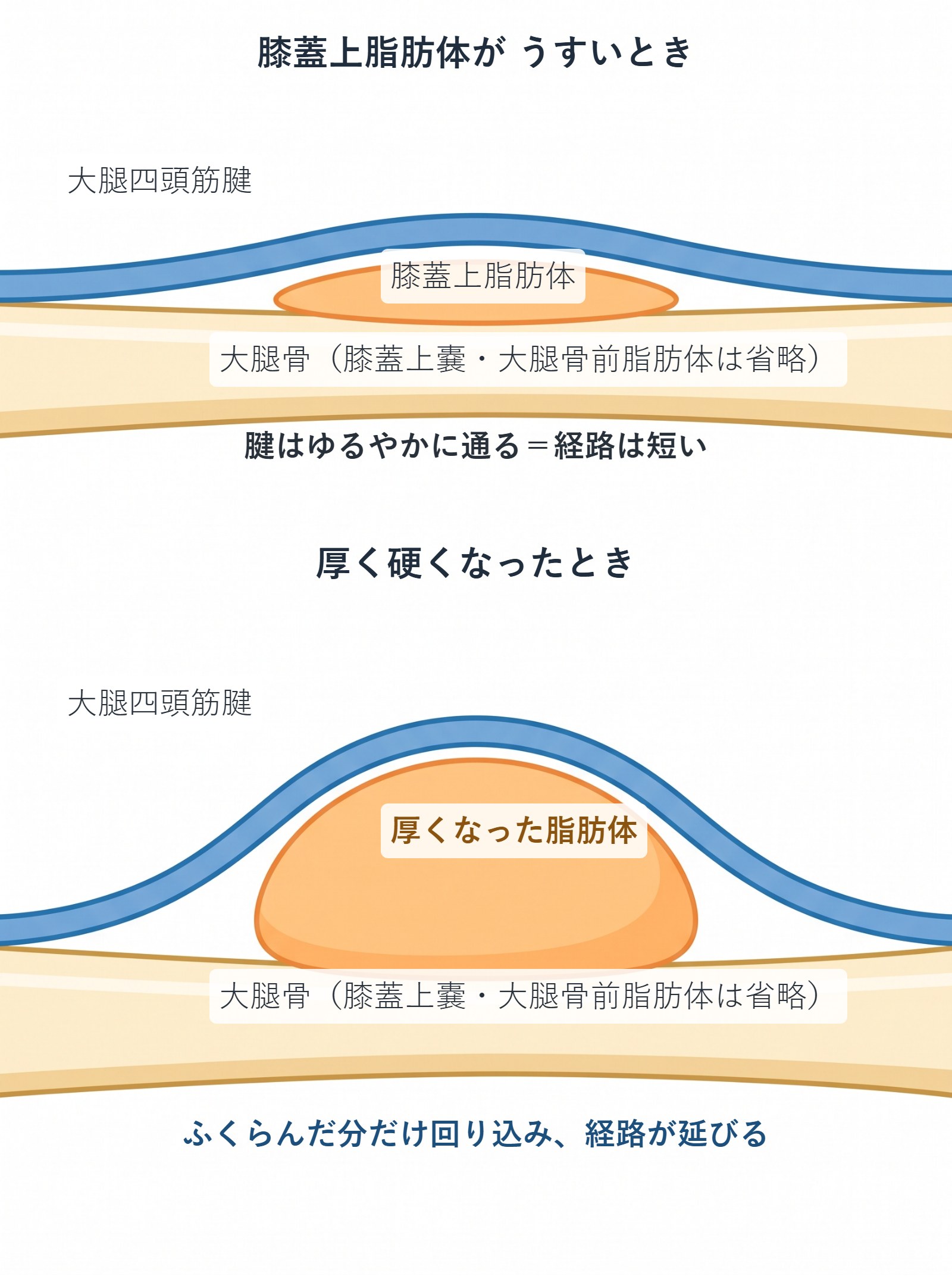 膝蓋上脂肪体が肥厚すると、その上を通る大腿四頭筋腱が大きく回り込み、走行距離が延びることを示した概念図