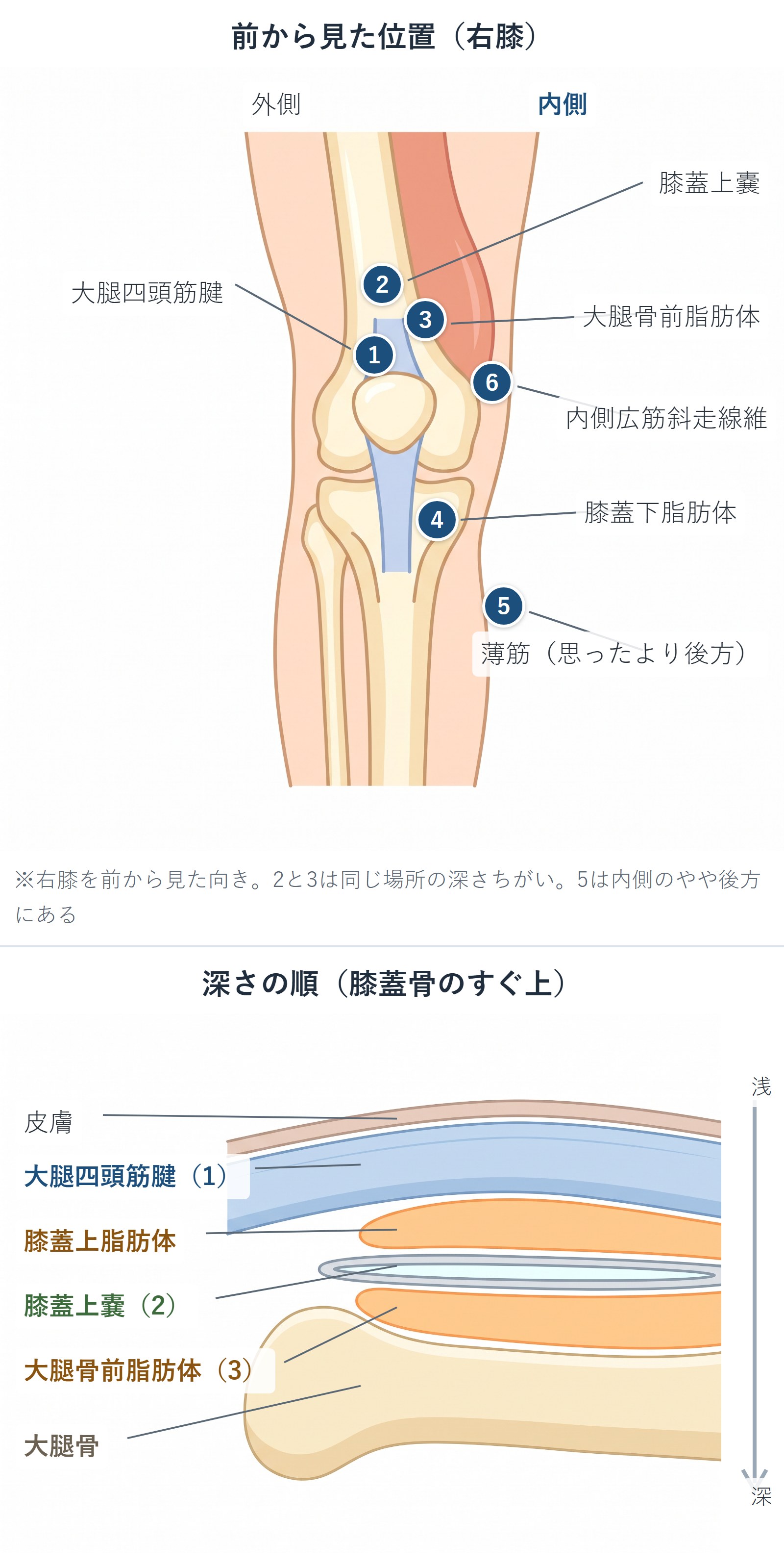 制限因子となる6組織の位置を前から見た右膝の図で示し、あわせて膝蓋骨上の深さの順（皮膚・大腿四頭筋腱・膝蓋上脂肪体・膝蓋上嚢・大腿骨前脂肪体・大腿骨）を積み重ねで示した概念図