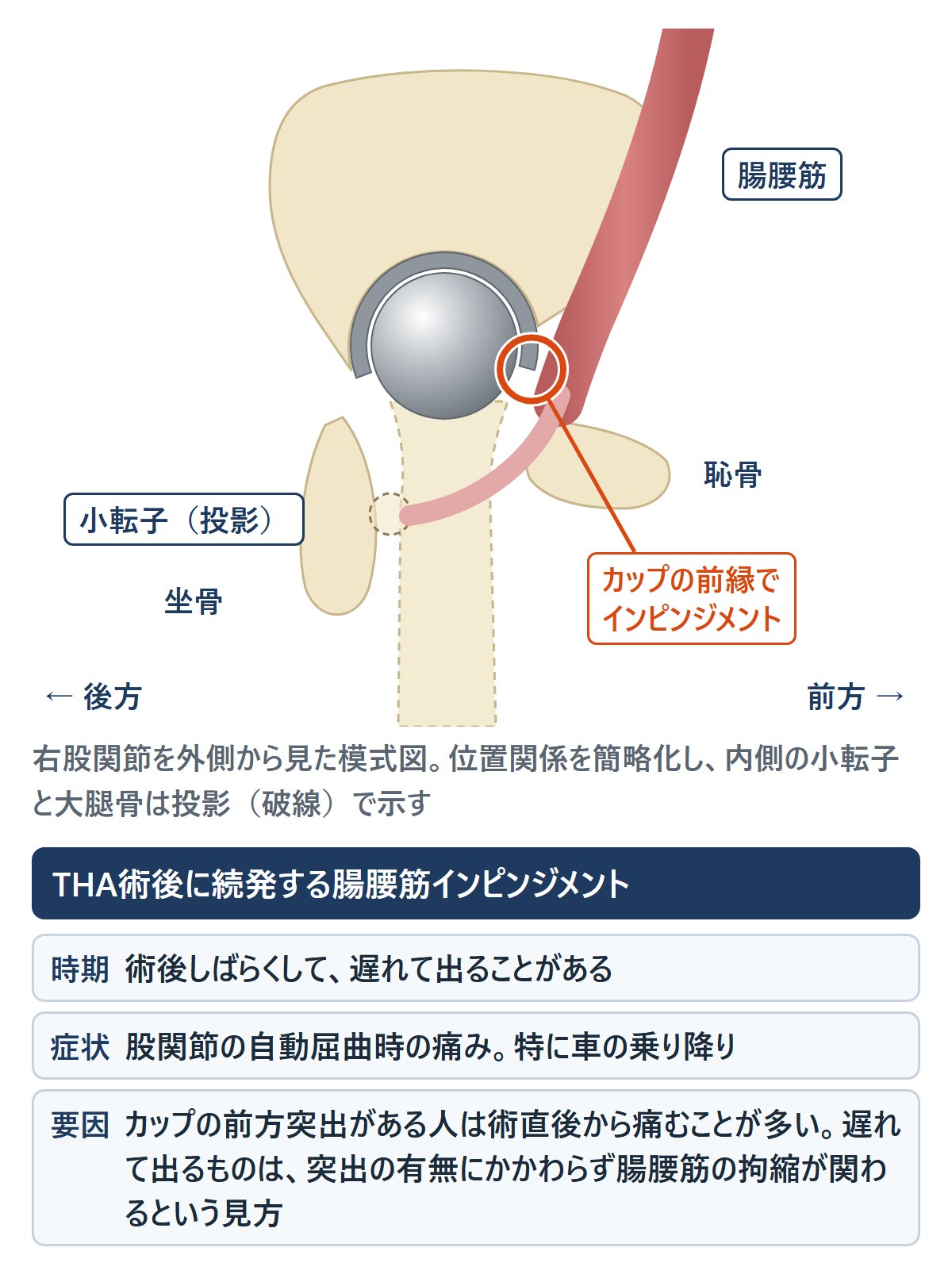 腸腰筋がカップの前縁でインピンジメントを起こす場所