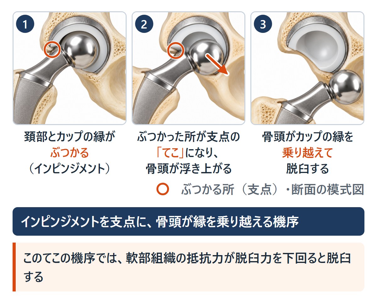 インピンジメントを支点にした脱臼の3段階