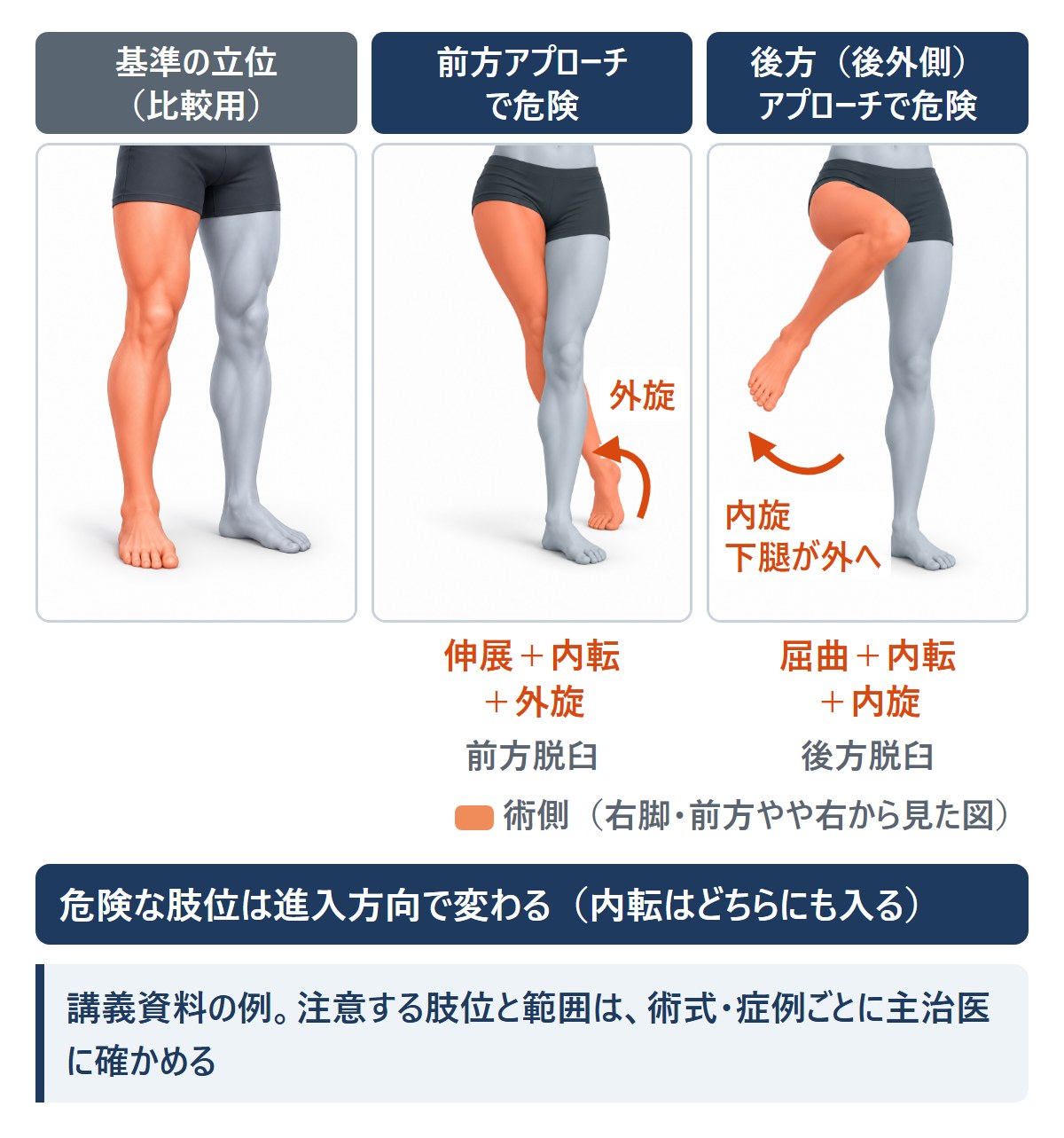 THA術後の脱臼の危険肢位:進入方向で変わる