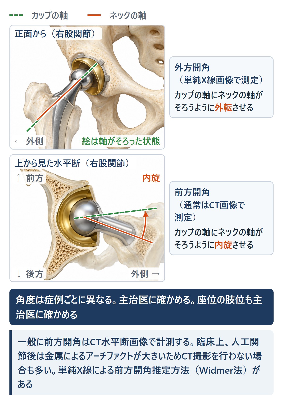 外方開角と前方開角:カップの軸に頚部の軸をそろえる